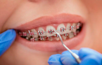 How Braces Improve Your Smile and Confidence Every Single Day