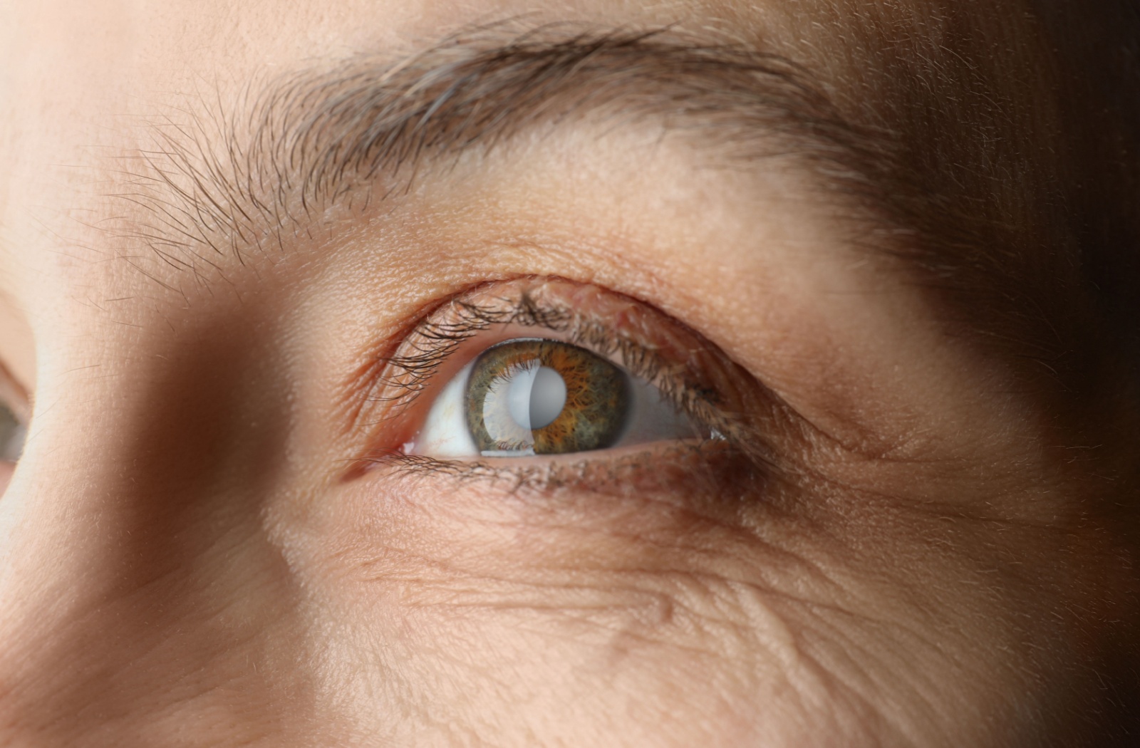 How Can You Protect Your Eyes from Cataracts and Glaucoma?